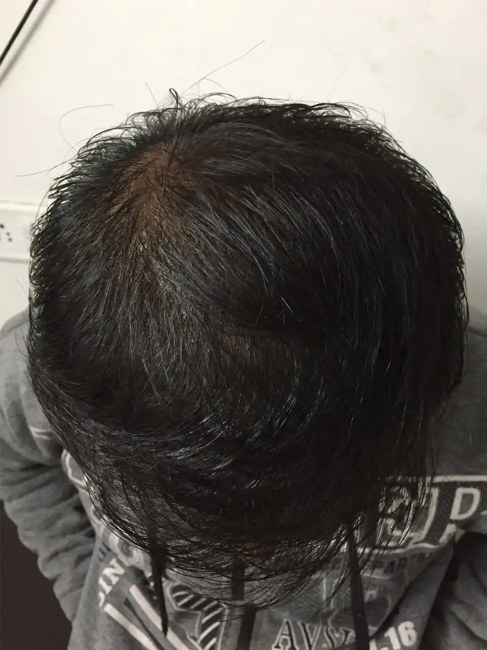 6 Hair Issue After