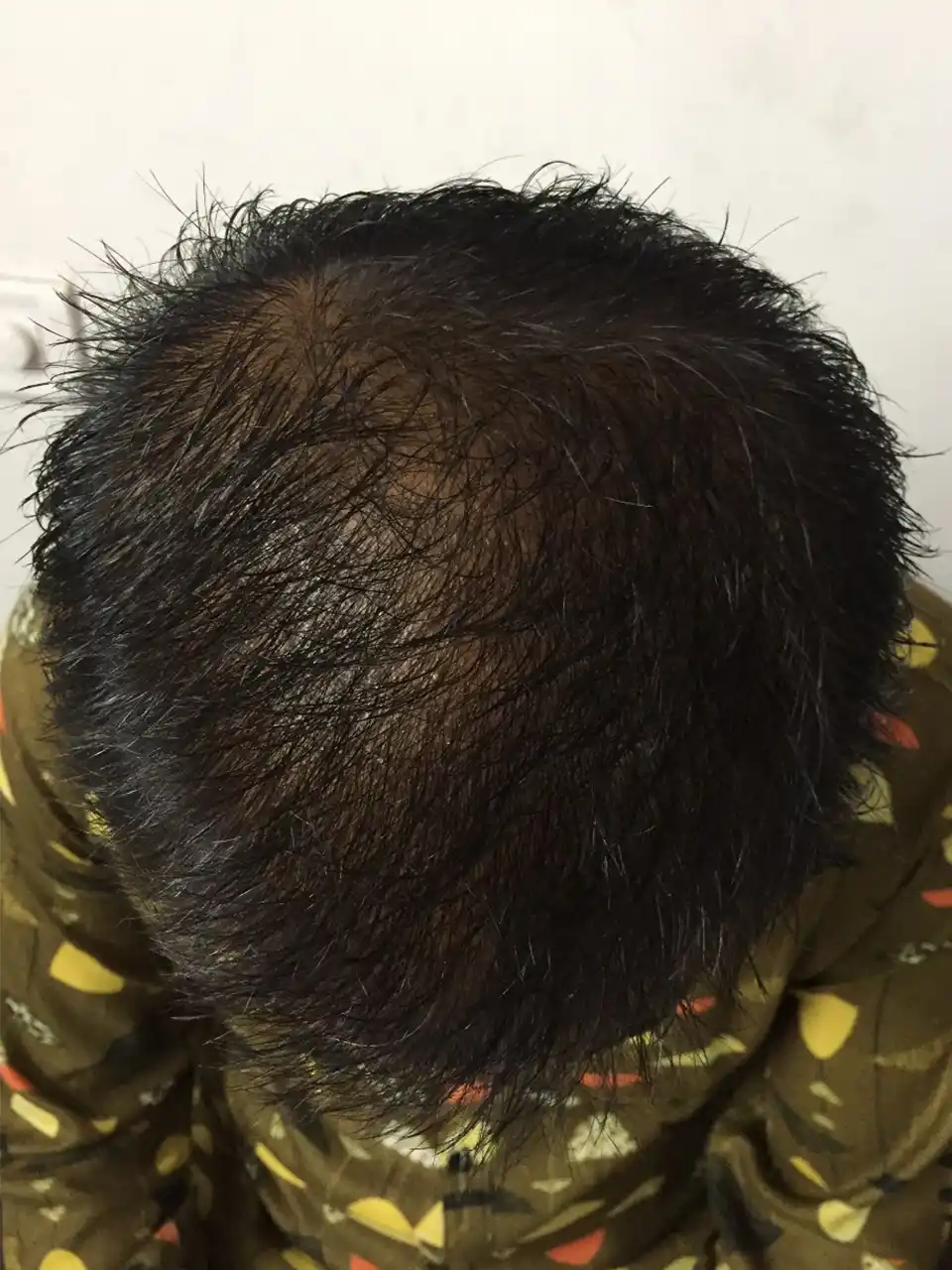 6 Hair Issue Before