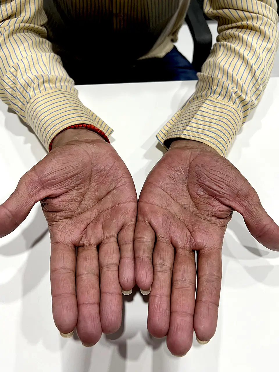 11 After Pustular Psoriasis Of Hands