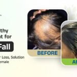 Homeopathy Treatment For Hair Fall